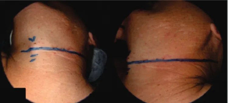 Figure 1.   Single extended transverse incision for cervical dissection, located in the mid third of the neck region and coincident with the skin fold,  surpassing the midline and the anterior border of the trapezius muscle.