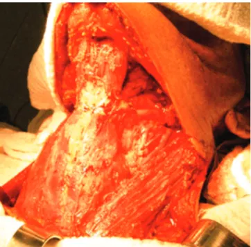 Figure 2.   Bilateral cervical lymph node emptying with exposure of all  lymph node levels.