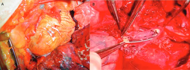 Figure 1.   Aspects of cardiac and vascular damagecontrol. A) Cardiac wound synthesis with metal clips through an left anterolateral thoracotomy; 