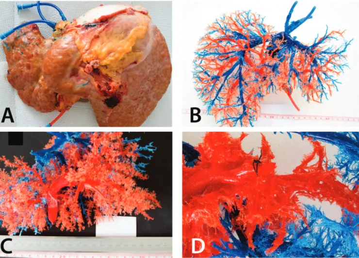 Figure 1.   A) Posterior aspect of the liver, with catheters in the hepatic (blue) and portal (red) veins; B) Hepatic venous bed, after complete removal  of the parenchyma