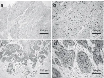 Figure 3 -   a) Immunostaining for p16INK4a protein in the surface areas  of the tumor; b) Nuclear and cytoplasmic immunostaining  pattern for p16INK4a; c) Immunohistochemistry  positivi-ty for Ki-67 antigen predominantly in basal and parabasal  layers of 