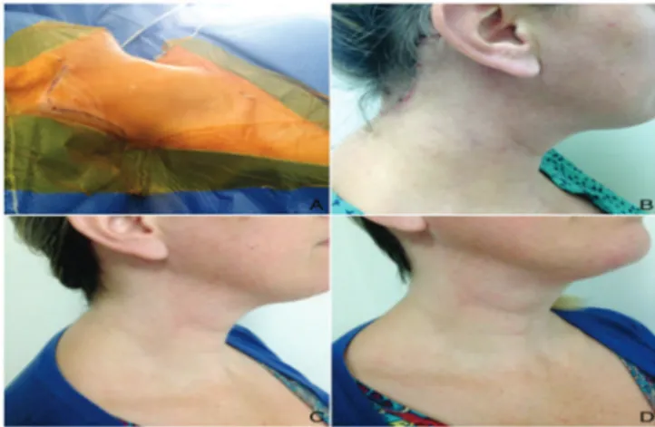 Figure 2.   Ongoing neck dissection and the magnification of the dis- dis-sected structures