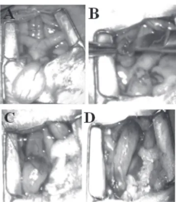 Figure 2.   A) dilated ureter in its near-bladder segment; B) opening of  the ureter, displaying  the stone street within; C) several  mul-tifaceted calculi, the biggest measuring 5mm.