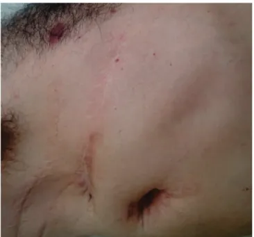 Figure 3.   Anterolateral aspect of the patient’s right chest, 22 months  after the end of NPT, with healed wounds.