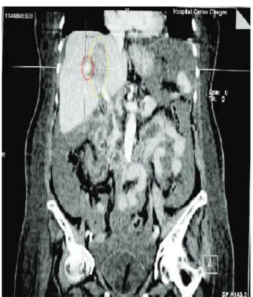 Figure 1.   Abdominal CT scan with contrast showing right hepatic ar- ar-terial malformation (smaller circle) and intra-parenchymal  hematoma (larger circle).