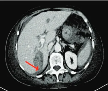 Figure 2.   CT: section showing abundant hemoperitoneum. Figure 3.   CT: hematoma rupture and extravasation into the peritoneal  cavity (arrow).