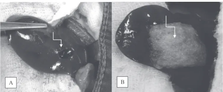 Figure 1. A) Hepatic Injury (2x magnification); B) Final aspect of the adhesive, indicated by the arrow on the liver injury (2x magnification)