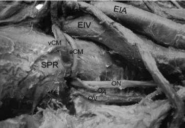 Figura 1. Dissecação de uma hemipelve direita. Vista anterior. A corona  mortis pode ser observada acima do ramo superior da pube.