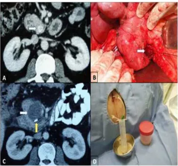 Table 2 - Distribution of types of pancreatic resections.