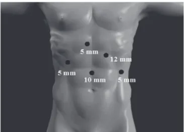 Figure 1.  Insertion of the trocars for realization of the laparoscopic  resection of gastric submucosal tumors after instilation of  the pneumoperitoneum.
