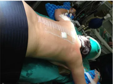 Figure 1. Prone position with cushions and restraint bands.