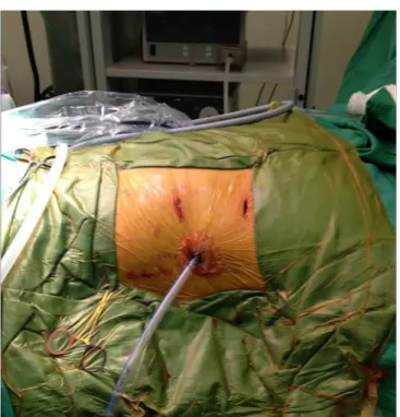 Figure 4. Thoracic drainage positioned through the endoscope port.