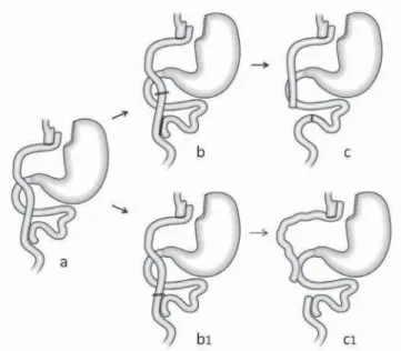 Figure 1.   Roux-en-Y gastric bypass modified by the inclusion of the  duodenum and proximal jejunum in the food transit as the  primary surgery