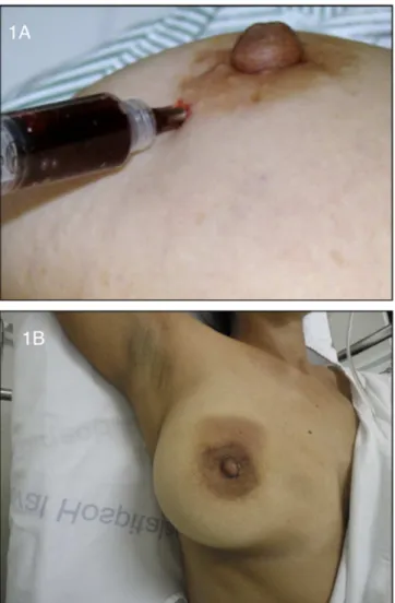 Figure 1. A ) Subareolar injection of hemosiderin; B) Site post-injection  of hemosiderin (hematoma post-injection).