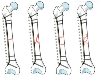 Figure 1.   Representation of the types of fractures.