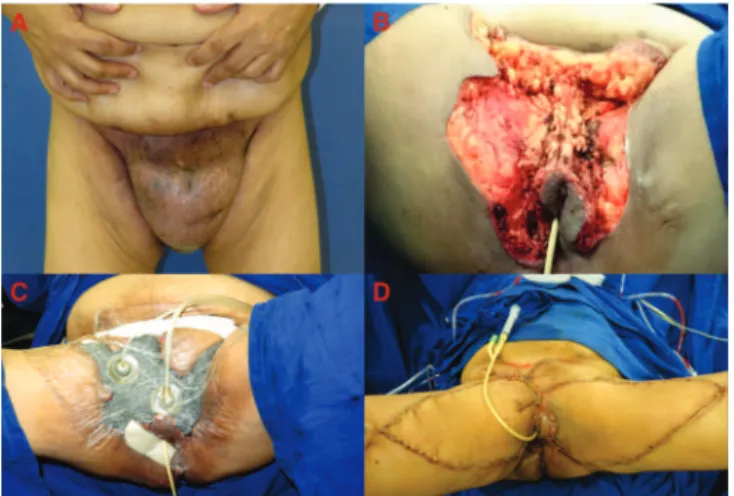 Figure 1.   Contaminated, degloving wound on left leg.