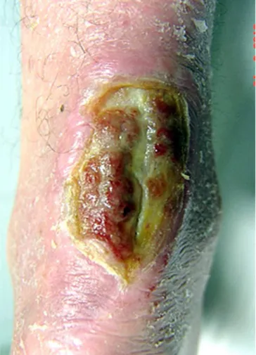 Figura 2. Punch grafts em ulceração de pé diabético: transoperatório.