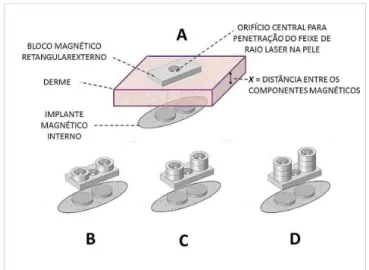 Figura 3. A) Bloco externo + implante; B, C e D) Ímãs adicionados.