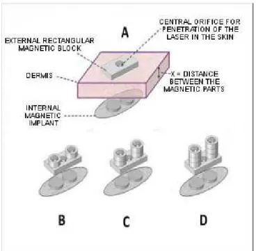 Figure 3. A- External block + implant; B, C, D- Magnets added.