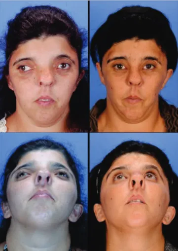 Figure 1.  (Left) Preoperative frontal and basal photographs of  a 29-year-old female patient with craniofrontonasal  syndrome (unilateral left coronal craniosynostosis,  asymmetric hyperteleorbitism, bifid nose, low V-line  implantation, low ears implanta