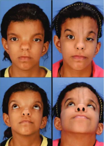 Figure 2.   (Left) Preoperative frontal and basal photographs of an  11-year-old patient with craniofrontonasal syndrome (bilateral  coronal craniosynostosis, symmetrical hyperteleorbitism, bifid  nose, low ears implantation, palpebral ptosis, medial epica