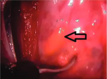Figure 3. Identification of the recurrent laryngeal nerve. Figure 4. Parathyroid identification.