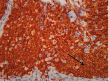 Figure 1.   p16 ink4a ; 200x magnification. Nuclear cells with marker ex- ex-pression in more than 50%.