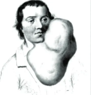 Figure 3.   “Case Books” parotid tumor (John Hunter).