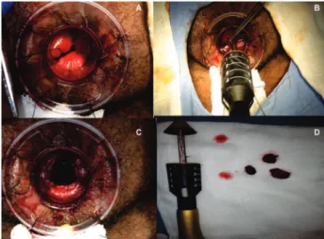 Figure 1.   Partial stapled hemorrhoidopexy.