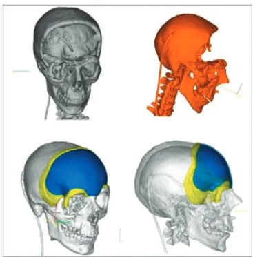 Figure 2. 3D Biomodel and implant fixed in the skullcap.