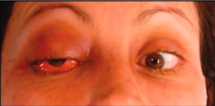 Figura 1.   Paciente com FCCd apresentado proptose, hyperemia ocular  e deficit do NC VI à direita.