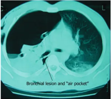 Figure 1.   Bronchial lesion diagnosed by computed tomography. Noti- Noti-ce continuity solution in the right stem bronchus and  accu-mulation of air, just below the lesion.