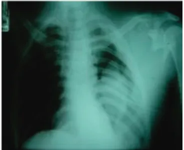 Figure 2.   Chest radiograph. “Fallen lung” sign and complex scapular  fracture to the left, denoting a high-energy trauma.