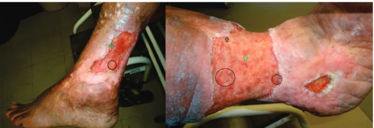 Figura 2.   Úlcera varicosa, após 120 dias: A) Grupo Celulose Bacteriana; B) Grupo Controle
