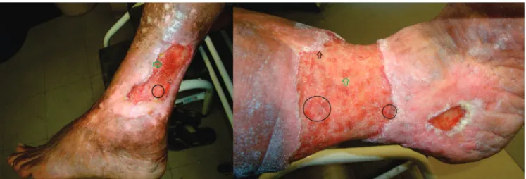 Figure 2.   Varicose ulcer after 120 days: A) Bacterial Cellulose Group; B) Control Group