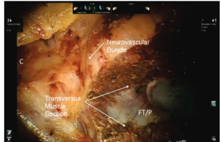 Figure 1. Dissection of the rectusposterior sheath. Figure 2. Transversus muscle section – TAR.