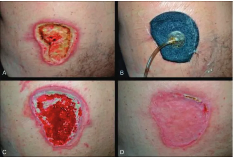 Figure 1.   Male patient, 58 years old, paraplegic. A) Pressure ulcer in the left lumbar region, with wound bed filled with devitalized tissues; B) Appli- Appli-cation of NPT after surgical debridement; C) Appearance after NPT, with improvement of granulat