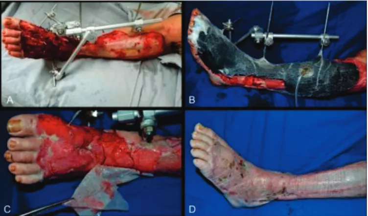 Figure 2.   A 30-year-old male patient, victim of an automobile accident. A) Degloving (detachment injury) of the left leg; B) Application of NPT,  allowing growth of granulation tissue on initially exposed bones and tendons; C) Aspect after maturation of 