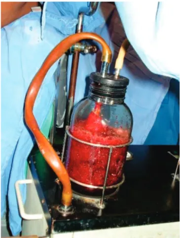 Figure 1. Uterine aspiration (electric).