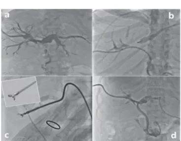 Figure 1.  A) Cholangiography with dilatation of the bile ducts and  obstruction in the confluence of the hepatic ducts; B)  Oper-ator’s hand keeping the sheath against the obstruction; C)  Detail of the forceps used with a spike; D) The obstruction is  cr