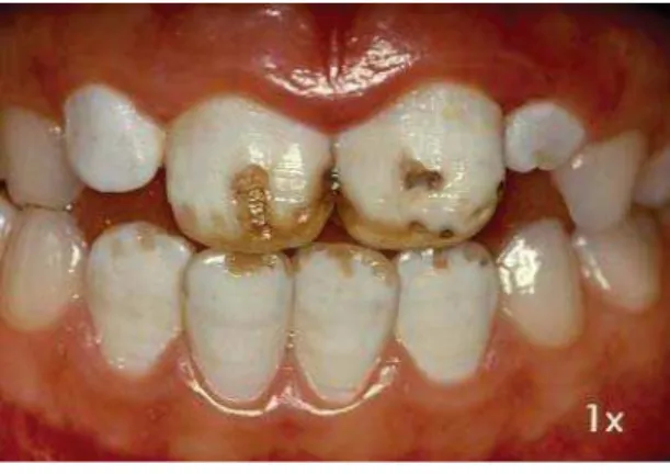 Figure 1. Rounded and delimited stains caused by non- non-fl uorotic opacity.
