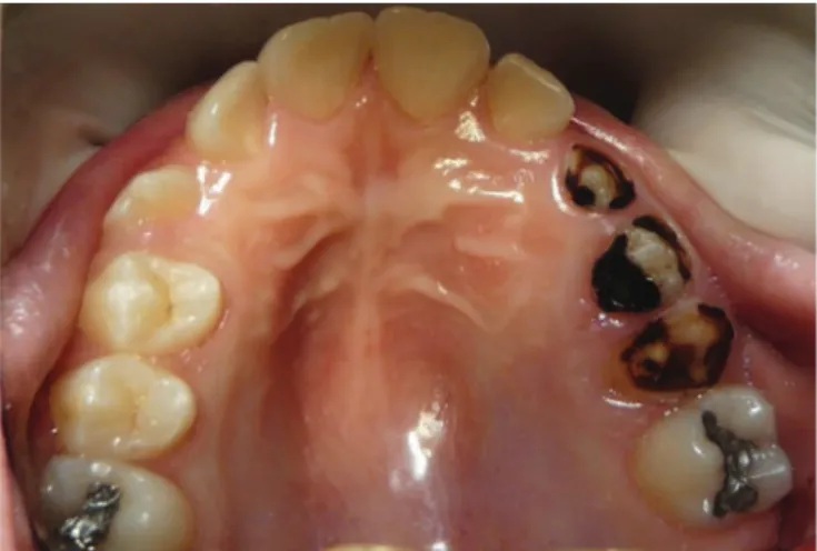 Figure 1. Occlusal view of maxillary arch.