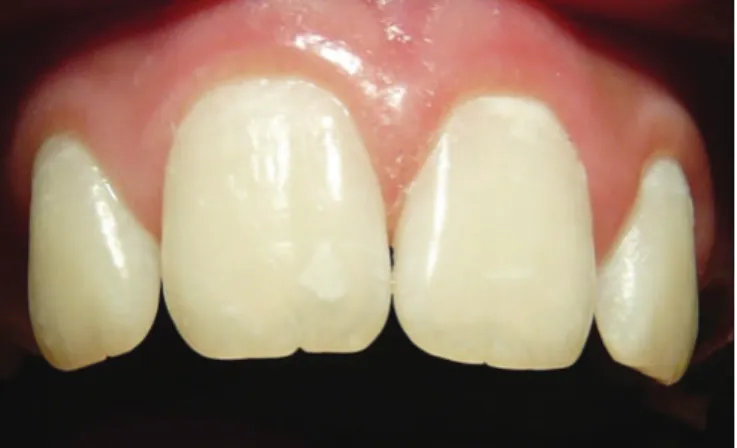 Table 1 shows the results for deciduous teeth, and Table 2 shows  the results for permanent teeth.