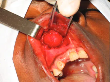 Figure  2. Panoramic radiograph identifying bone rarefaction  suggestive of lesion in maxillary right canine region.
