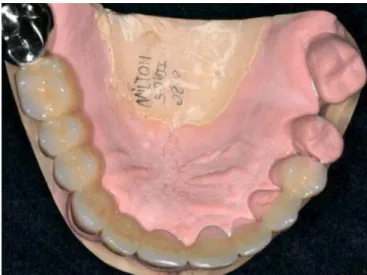 Figure 1. Frontal view–anterior crossbite. Figure 2. Transitional acrylic overlay.