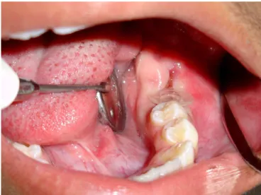 Figure 1. Panoramic radiograph showing a radiolucent area related  to a permanent mandibular let second molar.