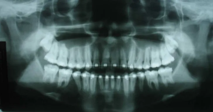 Figure  4. Panoramic radiograph showing a signiicant decrease in  lesion size and eruption of the mandibular let third molar.