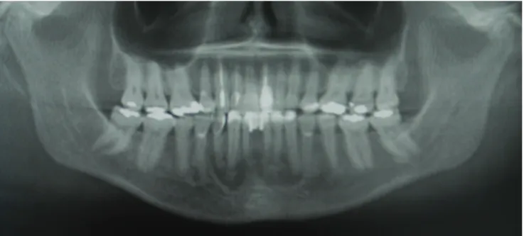 Figure  4. Panoramic radiograph of the patient showing FCOD  lesions of the anterior mandibular area extending to the second  premolar area.