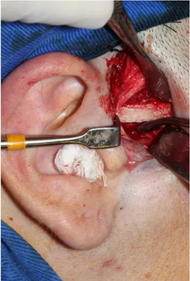 Figure 1. Restriction of mouth opening using Erich bars and elastic. Figure 2. Resection of the articular eminence - right side.