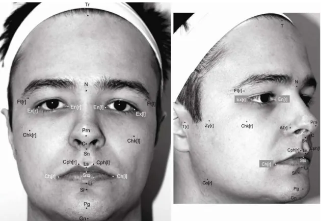 Figure 2. Marking of the hemiface area, growth angle T-Go-Pg, the lip area and linear distances of the lips for viewing of the Vectra®- 3D  dimensional image processing sotware.